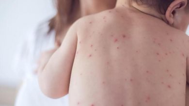 هشدار شیوع آبلهمرغان در فصل بهار