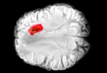 کشف دارویی برای مبارزه با کشنده‌ترین سرطان‌های مغز
