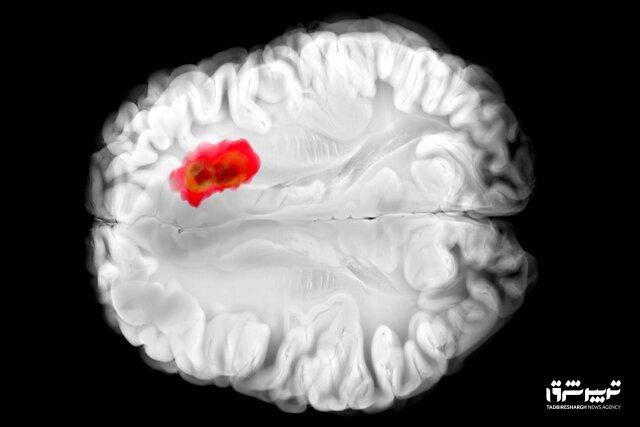 کشف دارویی برای مبارزه با کشندهترین سرطانهای مغز